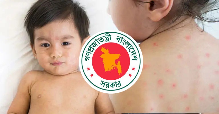 হাম উপসর্গে আরও ৬ শিশুর মৃত্যু